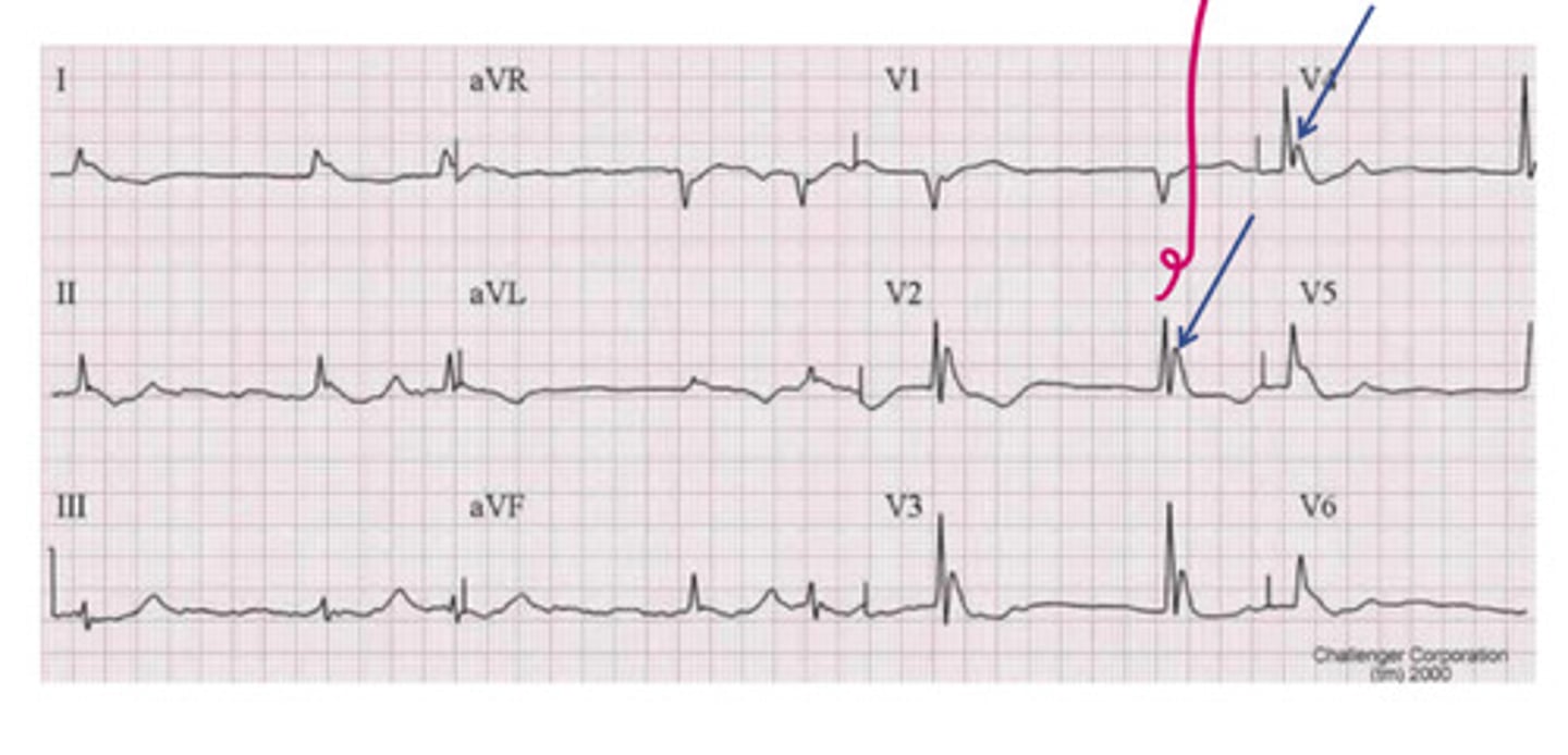 <p>this is an example of ______, which is characterized by _____ waves</p>