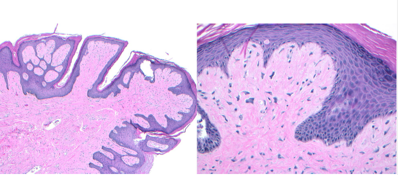 <ul><li><p><strong>papillary surface</strong></p></li><li><p>presence of <strong>giant </strong>stellate-shaped fibroblasts in the lamina propria</p></li></ul><p></p>