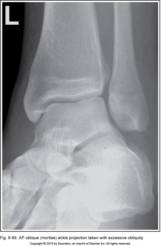 <p>AP ankle oblique (mortise)</p>