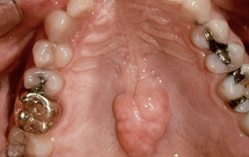<p>exophytic growth of normal compact bone on the hard palate</p>