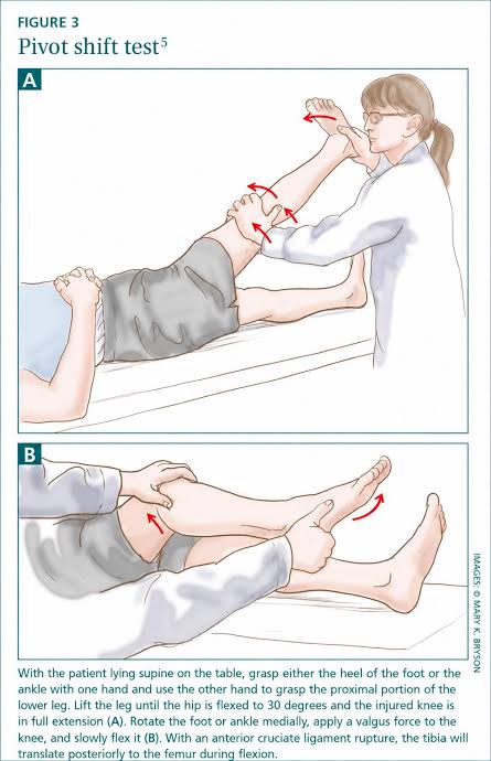 <p>Lateral pivot shift test </p>