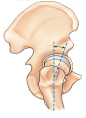 <p>What is the angle between the head of the femur and the neck in relation to the body of the femur in a natural position?</p>