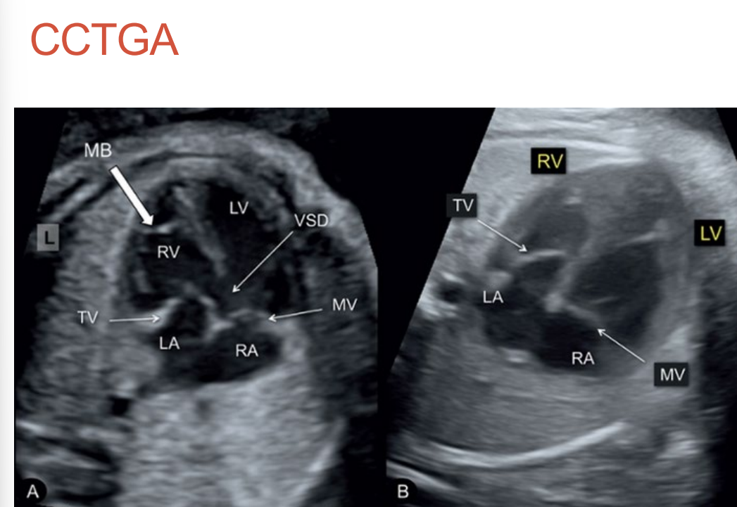 <p>4 chamber will show ventricular inversion • Moderator band • </p><p>Inferior placed tricuspid valve • Possible TR </p><p>• Mesocardia in 25% of cases </p><p>• 5 chamber may show vessels running parallel • Look for PA branches</p>