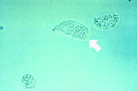 <p>Identify the urine sediment elements shown by the arrow:</p><p>Note that these elements showed a Maltese cross pattern under polarized light.</p>