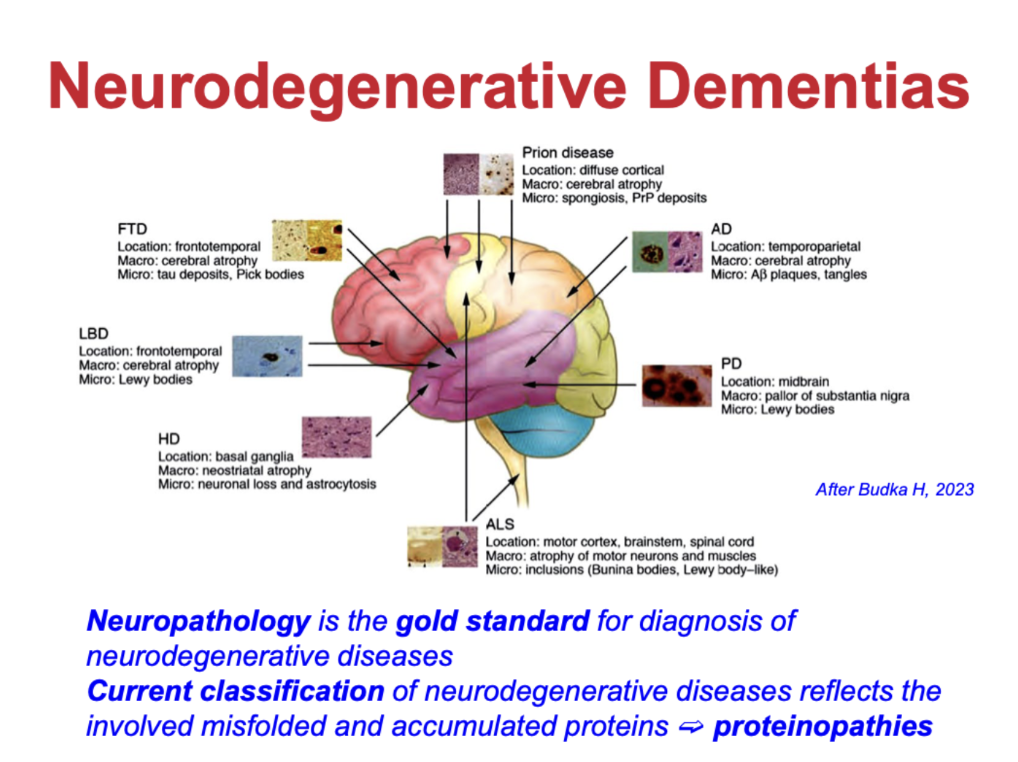 <ul><li><p>Classified by <strong>misfolded/accumulated proteins → “proteinopathies”</strong></p></li><li><p>Examples:</p><ul><li><p><strong>Alzheimer’s disease (AD):</strong> Aβ plaques, tau tangles</p></li><li><p><strong>Parkinson’s disease (PD) / Lewy body dementia:</strong> α-synuclein (Lewy bodies)</p></li><li><p><strong>Frontotemporal dementia (FTD):</strong> tau or TDP-43</p></li><li><p><strong>Prion diseases:</strong> misfolded prion protein</p></li><li><p><strong>Huntington’s disease (HD):</strong> mutant huntingtin</p></li><li><p><strong>ALS:</strong> protein inclusions (e.g. TDP-43)</p></li></ul></li><li><p><strong>Neuropathology = gold standard</strong> for diagnosis</p><ul><li><p>Disease type depends on <strong>which protein accumulates and where in the brain</strong></p></li></ul></li></ul><p></p>