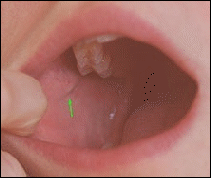 <p>Bidigital palpation and stripe buccal mucosa from back to front.</p>