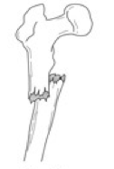 <p>Overriding Fracture</p>