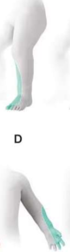 <p>this limb deficiency would be considered ___________</p>