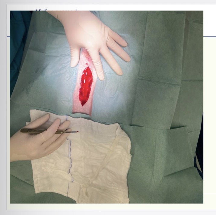<p>Surgical technique - incision </p>