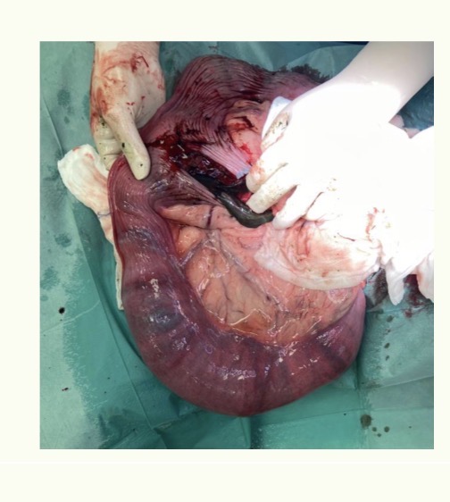 <p>Surgical technique - Steps </p>