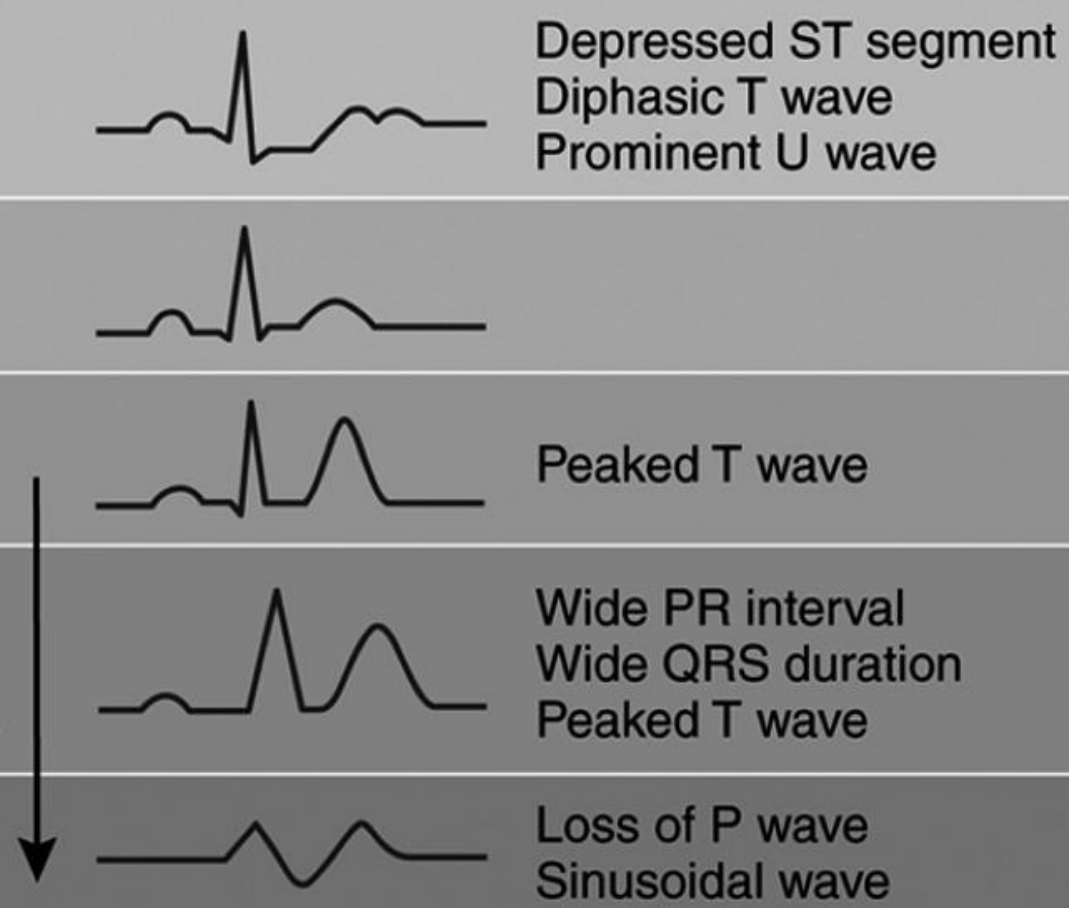 <p>Effects of K Imbalance on Cardiac Conduction: _____ (depressed ST segment, diphasic T wave, prominent U wave), increasing severity of ______ (wide PR interval, wide QRS duration, peaked T wave) and eventually leads to loss of P wave and sinusoidal wave</p>