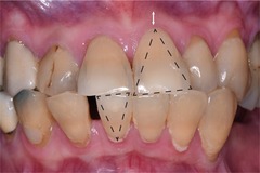 <p>thin scalloped biotype</p>