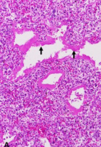 <p>ID this condition and note its cuase and primary features </p>