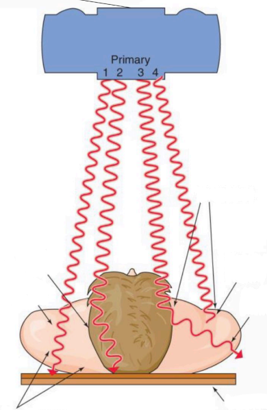 <p>Interacted with patient, scattered and then happened to strike IR. (2)</p>