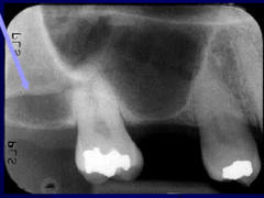 <p>Radiopaque U- or J-shaped structure above maxillary molars</p>