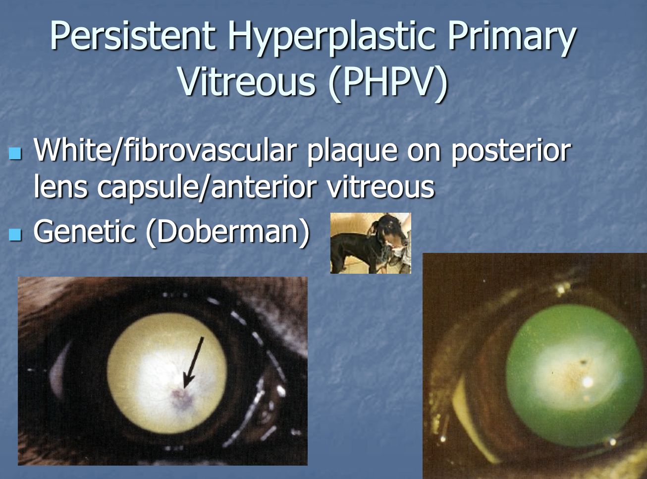 <p>White/fibrovascular plaque on posterior lens capsule/anterior vitreous.</p><p>Genetic in Dobies.</p>