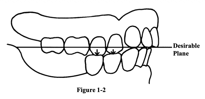 <p>How can you estimate the amount of wear in the antero-posterior view of the occlusal plane?</p>