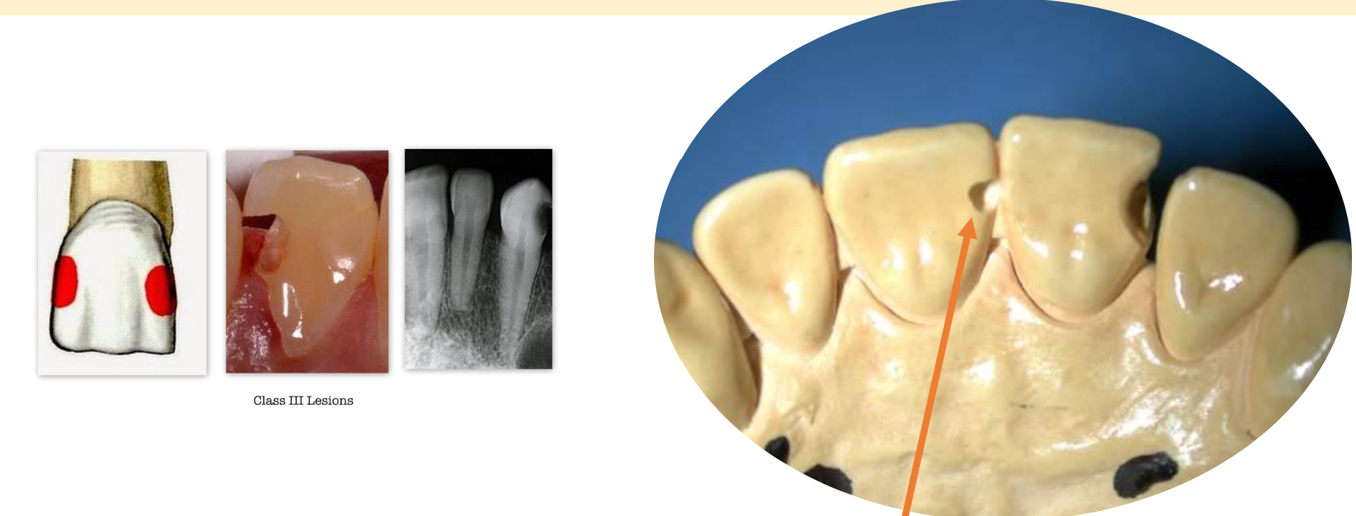 <p>Smooth proximal surfaces of anterior teeth</p><p>(incisors and canines)</p>