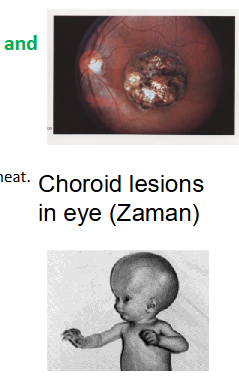 <p>Toxoplasma gondii - pathology</p>