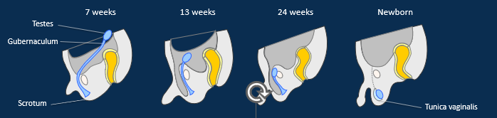 <p><span>•Testes develop in the abdominal cavity, fixed in position by a connective tissue cord - the <strong>gubernaculum</strong>.</span></p><p><span>•As fetus grows, the testes become more anterior/ inferiorly positioned relative to the body.</span></p><p><span>•From fetal month 7, rapid growth and hormones stimulate the gubernaculum to contract, and testes are pulled into the scrotum through the anterior abdominal wall, creating the <strong>inguinal canal</strong>.</span></p><p><span>•Testes take blood/ lymph vessels and nerves with them, forming the <strong>spermatic cord</strong>.</span></p><p><span>•Portion of peritoneum separates to form serous membrane around testes, called the <strong>tunica vaginalis</strong>. Abdominal skeletal muscle forms a layer of <strong>cremaster muscle </strong>around the testes (cremaster reflex).&nbsp;</span></p><p><span>•Cryptorchidism (undescended testes) occurs in 1:25 full term births (higher rates in premature births).</span></p>