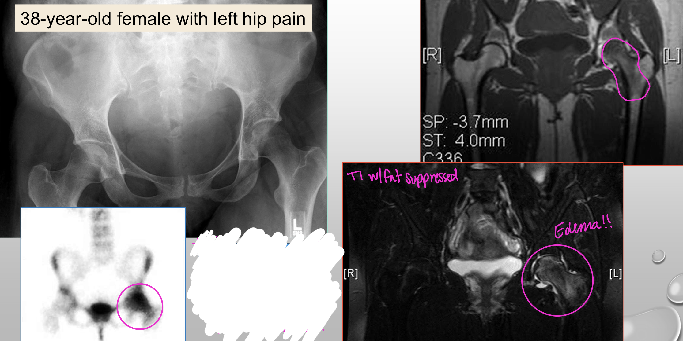 <p>What type of secondary osteoporosis does this pt have</p>