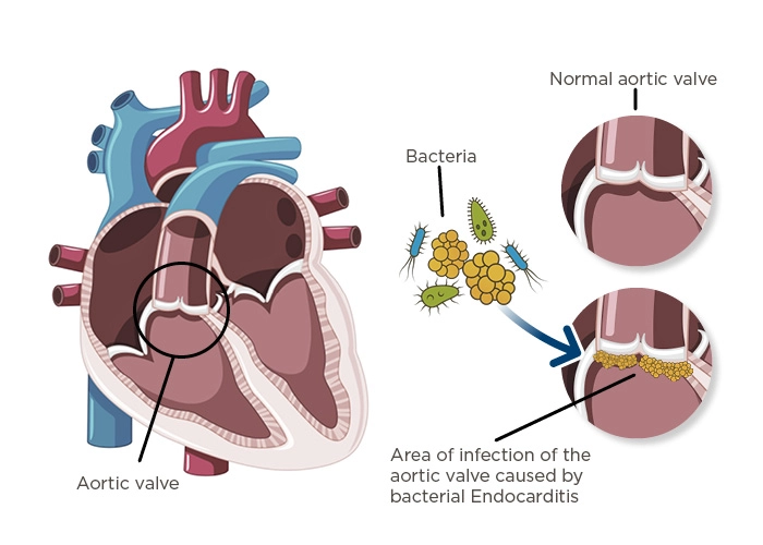 <p>An <strong>infection of the inner lining of the heart (endocardium)</strong>, usually affecting the <strong>heart valves</strong>.</p>