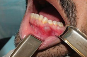 <p>A 43-year-old male patient with a complaint of painless swelling in the left mandibular premolar region. Although the history revealed a presence of the swelling for more than one year without any associated symptoms, the patient preferred to obtain clinical consultation as he was concerned about the swelling. The patient had no previous history of dental treatment except for periodic oral prophylaxis. Provide two differential diagnosis</p>