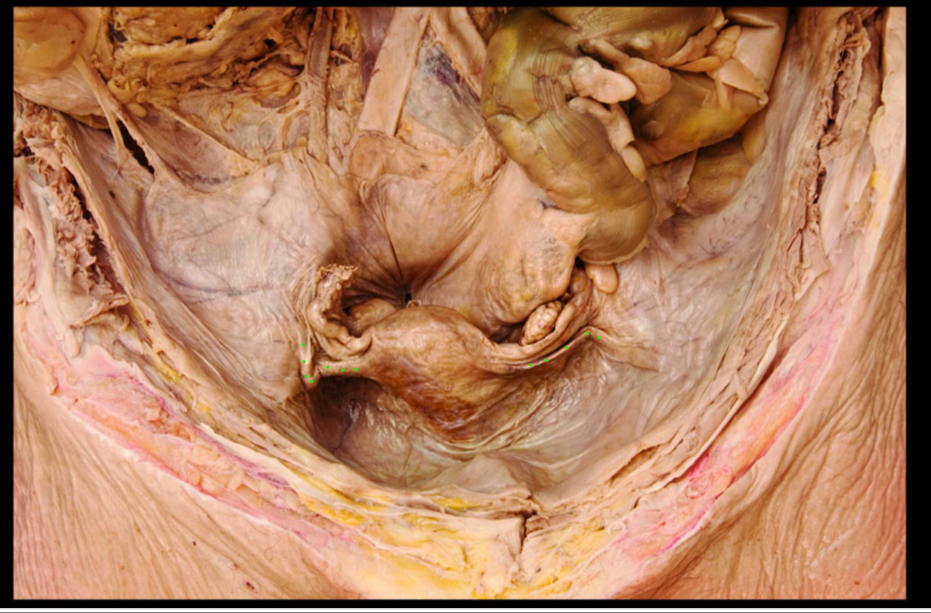 <p>(within the broad ligament)</p>