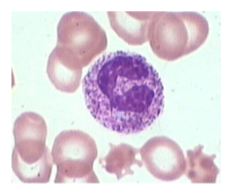 <ul><li><p>Dark staining of prominent granules in cytoplasm of neutrophils</p></li><li><p>Conditions: bacterial infections</p></li></ul><p></p>