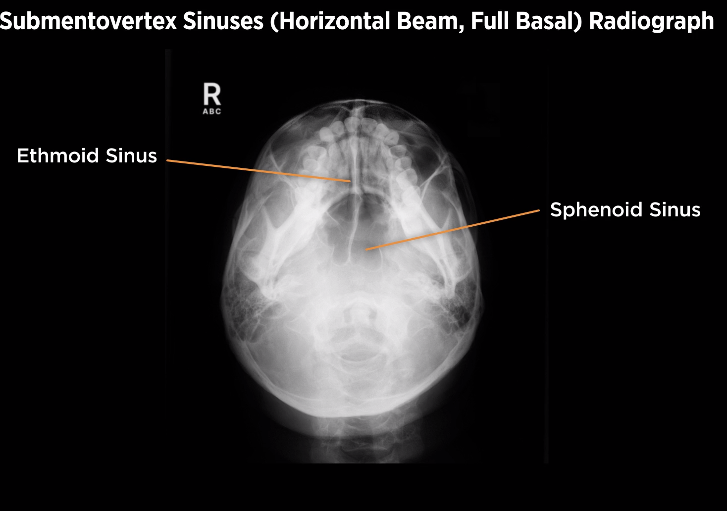 <p>Inferosuperior SMV Sinus projection (full basal)</p>