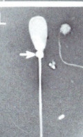 <p>What is this? Normal or abnormal sperm?</p>