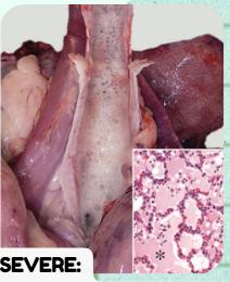 <p>PULMONARY EDEMA</p><p>In severe cases of pulmonary edema, what specific fluid type fills the bronchi and trachea, and what mechanical action generates it?</p>