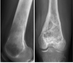 <p>What is this?</p><p>- 30-50 yo</p><p>- Pain (Local pain + swelling of long duration)</p><p>- Metaphyseal around knee joint</p>