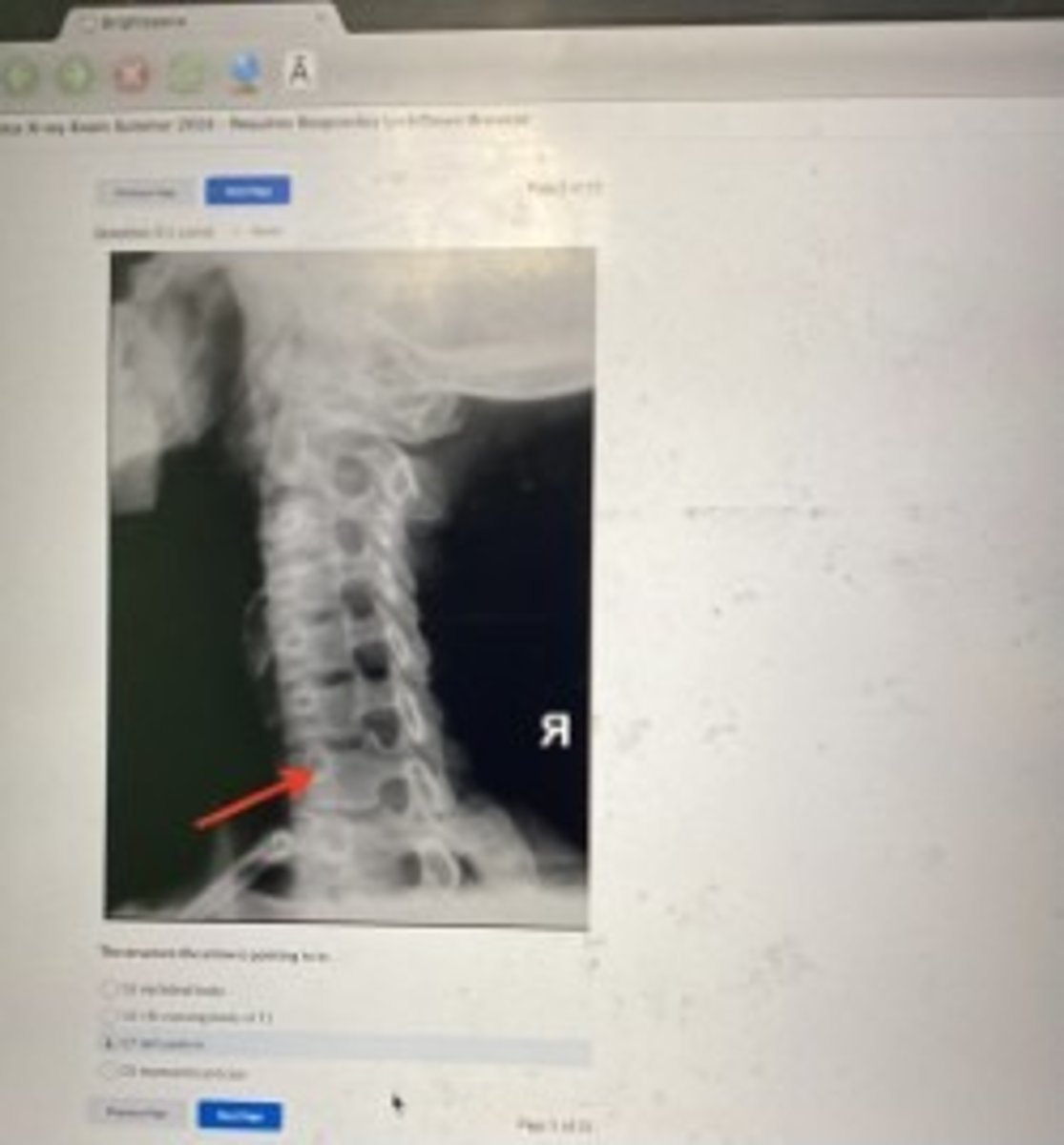 <p>C7 left pedicle</p>