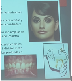 <ul><li><p><span style="background-color: transparent;">(dirección de crecimiento horizontal)</span></p></li><li><p><span style="background-color: transparent;">Los sujetos presentan caras cortas y anchas, con mandíbula cuadrada y musculatura fuerte</span></p></li><li><p><span style="background-color: transparent;">Las arcadas dentarias son amplias en comparación con las de los otros biotipos faciales</span></p></li><li><p><span style="background-color: transparent;">Este patrón es característico de las anomalías de clase II división 2 con sobremordida vertical profunda en el sector anterior</span></p></li></ul><p></p>