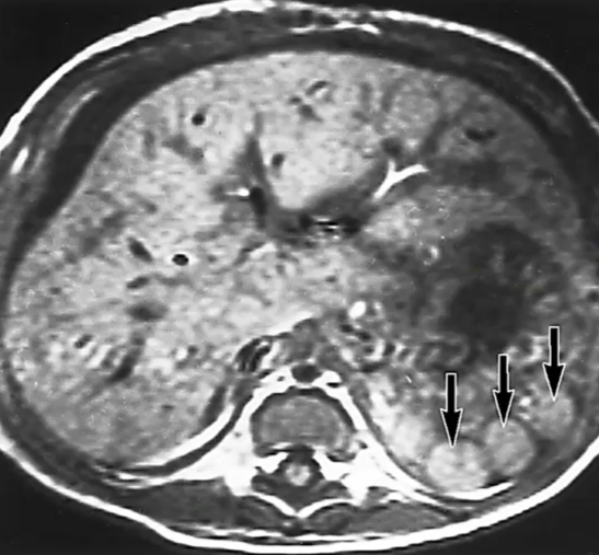 <p>What congenital spleen variant is associated with left sided laterality sequence (patient is more left sided than right sided)?</p>