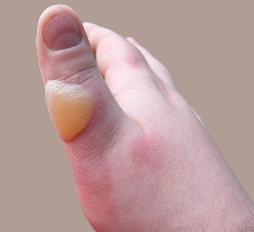 <p>scalding</p>