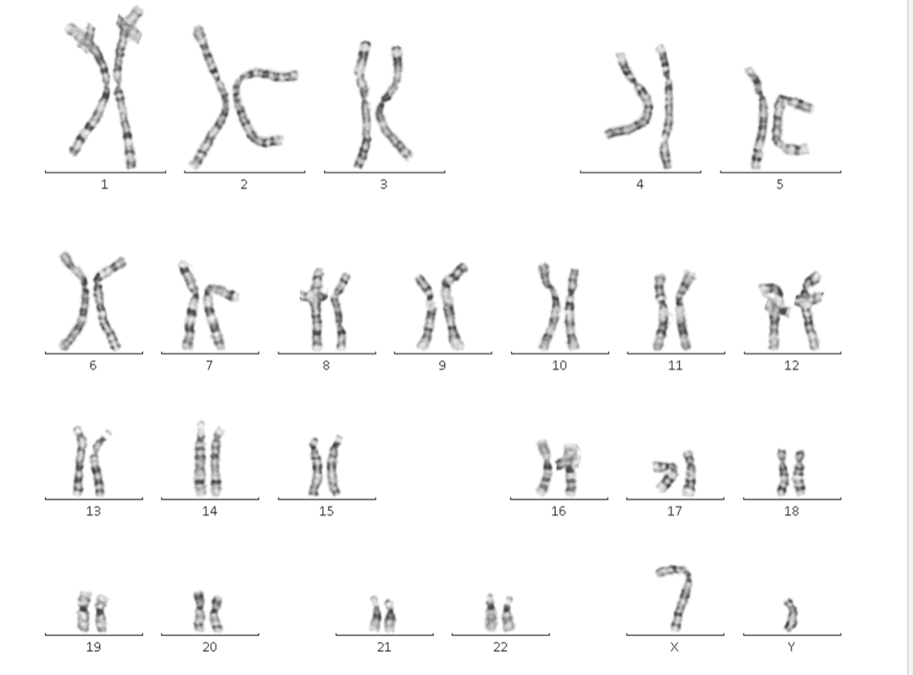 <p>23yo male with <strong><em><u>Developmental delays</u></em></strong> + seizures</p><ul><li><p>What can we tell from this karyotype?</p></li></ul><p></p>