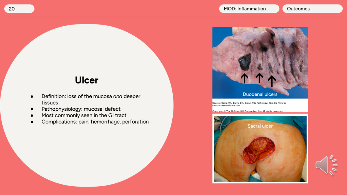 <p>Ulcer </p><p>Mucosal defect </p><p>seen in GI tract</p><p>pain, hemorrhage, perforation</p><p></p><p><span>●If only the mucosa is lost, the correct term is an <strong>erosion.</strong></span></p><p><span>●<strong>Microscopic morphology of an ulcer:</strong> The ulcer has four layers, which recapitulate steps from acute inflammation to repair. The layers, from superficial to deep, are fibrin, neutrophils, granulation tissue, and fibrosis.</span></p><p><span>●<strong>Complications of an ulcer:</strong> Pain; hemorrhage, if the ulcer involves a vessel; and perforation, resulting in hemorrhage within a cavity or the lumen of the gastrointestinal tract, or seeding of the peritoneal cavity with the contents of the gastrointestinal tract, causing peritonitis.</span></p>