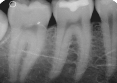 <p>Crowns Cut Off </p><p><strong>What it looks like:</strong><br>Top of teeth missing.</p>