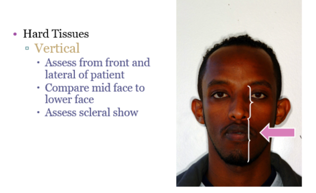 <ul><li><p>Facial third and increased scleral show - which is increased with hypoplastic maxilla </p></li></ul><p></p>