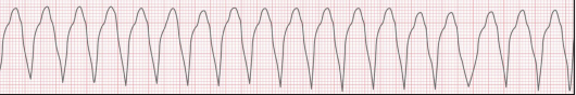 <p>What is the first line pharmacological treatment for stable VT? </p>