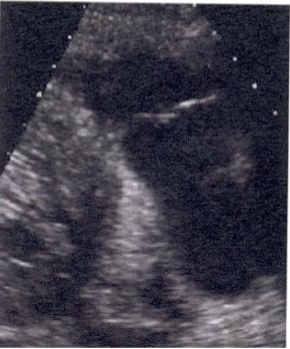 <p>PLAX RVOT </p>