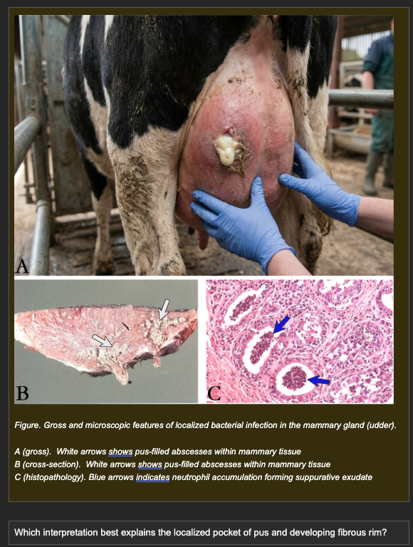 <p>A dairy cow develops acute bacterial mastitis. Treatment is delayed. Post-mortem examination of the mammary gland shows:</p><p>- Localized pocket of creamy yellow material within the parenchyma</p><p>- Histology: dense neutrophil accumulation with central liquefactive necrosis</p><p>- A developing fibrous capsule at the periphery of the necrotic core</p><p>- Viable mammary tissue immediately outside the fibrous rim</p><p></p><p><strong>Which interpretation best explains the localized pocket of pus and developing fibrous rim?</strong></p><p>a. Reduced vascular permeability prevents inflammatory cells from spreading, producing containment by limiting fluid escape</p><p>b. Reduced arterial blood flow limits the area of leukocyte delivery, confining infection and inflammation to a localized region</p><p>c. Increased lymphatic drainage removes inflammatory cells from the surrounding tissue, confining infection to the primary site</p><p>d. Persistent bacteria maintain ongoing neutrophil recruitment and tissue destruction, producing a localized core of liquefactive necrosis, while surrounding fibroblasts lay down a fibrous capsule that walls off the infection -- forming an abscess</p>