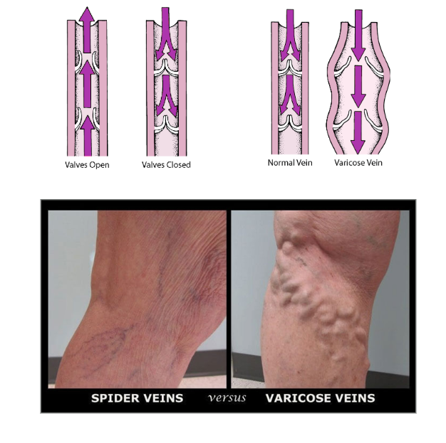 <p>What is notable about vein diameter and wall thickness?<br></p>