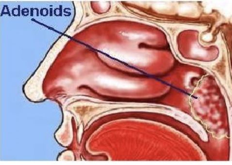 <ul><li><p>mass of lymphoid tissue</p></li><li><p>located on PPW behind velum</p></li><li><p>more prominent in children than adults </p></li></ul><p></p>
