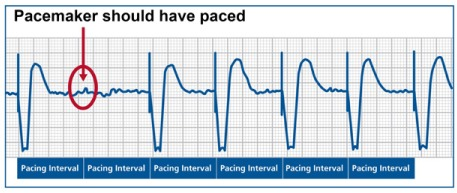 <p>No energy from pacemaker generator, can be intermittent or continuous </p><ul><li><p>EI>PI</p></li></ul><p></p>