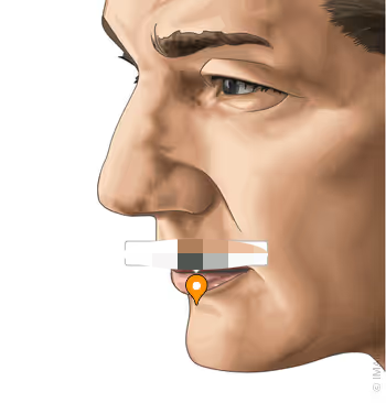 <p>the following picture is what extraoral landmark?</p>