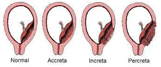 <p>A partir del segundo trimestre, la placenta toma el relevo en la producción de progesterona y estrógenos, haciendo innecesario el soporte del cuerpo lúteo. Como resultado, la hCG disminuye progresivamente</p><p>Las células trofoblásticas fetales tempranas invaden la capa basal de la decidua materna del endometrio</p><ul><li><p>Las células trofoblásticas no deben invadir el miometrio por debajo del endometrio</p></li><li><p>Cuando las células trofoblásticas invaden el miometrio, la situación se denomina placenta acreta.</p></li></ul><p></p>