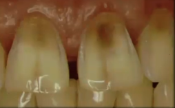 <p>What are some contraindications for veneers?</p>